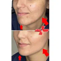 فیلر لب ،شقیقه، چانه،زاویهفک طبیعی با تکنیکتخصصی|خدمات زیبایی و سلامت|شیراز, معالیآباد|دیوار