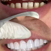 جشنواره کامپوزیت دندان