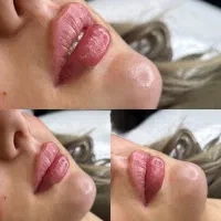 مرکز تخصصی فیلر و مزوژل جوانساز