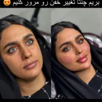 فیلر ژل بوتاکس بلفارو لیزر پی ارپی فول فیس مزو نخ
