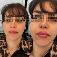 مرکزتخصصی لیفت بانخ و کانتورینگ صورت|خدمات آرایشگری و زیبایی|کرمانشاه, |دیوار