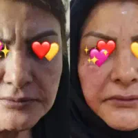 بوتاکس 1100ژل اودری800نخ لاغری1200وانزیم700مزوژل