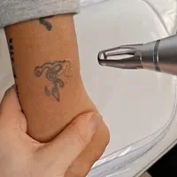 پاک کردن تاتو بدون درد با دستگاه کیوسوئیچ پیکوسکند|خدمات آرایشگری و زیبایی|ساری, |دیوار