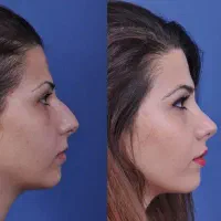 جراحی پلک(بلفاروپلاستی) / جراحی بینی/ جراحی غبغب|خدمات آرایشگری و زیبایی|شیراز, قصرالدشت|دیوار