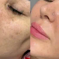 کرم ضدلک بدون بازگشت۳۵۰