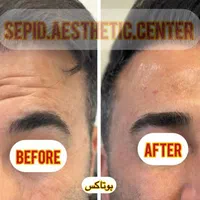 بوتاکس‌ ژل فیلر مزو خالبرداری‌ کرایو‌ وهایفو ولیزر|خدمات آرایشگری و زیبایی|تبریز, |دیوار