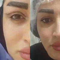 جراحی بلفارو پلاستی ساکشن غبغب بوکال فت سانترال .|خدمات آرایشگری و زیبایی|کرج, فاز ۳ مهرشهر|دیوار