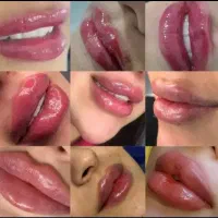 نیاز به مدل برای تزریق ژل