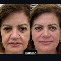 تزریق ژل بوتاکس فیلر در کلینیک زیبایی تهران|خدمات آرایشگری و زیبایی|تهران, یافت آباد جنوبی|دیوار