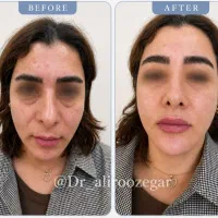 فیلر لب روسی فیلر زیر چشم فیلر گونه چانه توسط پزشک|خدمات زیبایی و سلامت|شیراز, ملاصدرا|دیوار