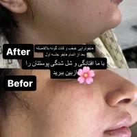 جشنواره زیبایی پوست با هایفوتراپی و آر اف فرکشنال|خدمات آرایشگری و زیبایی|قم, دورشهر|دیوار