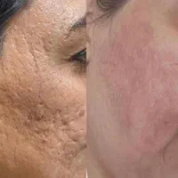 پرسینگ ناخن چال لپ پلاسمامیکرودرمال مرو خال مژه|خدمات آرایشگری و زیبایی|قم, شهرک فاطمیه|دیوار