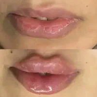 آف بلک فرایدی تزریق ژل بوتاکس فیلر ریمو تتو...|خدمات آرایشگری و زیبایی|علیآباد کتول, |دیوار