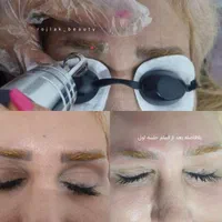 پاک کردن تتو و خالکوبی با لیزر کیوسوییچ پیکوشور