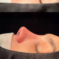 جشنواره عمل بینی به سبک جراحان ترکیه