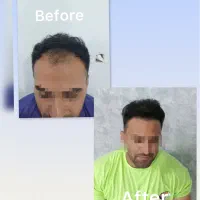 کاشت مو  ترمیمی ( ورتکس / شقیقه  )فقط ۸ میلیون