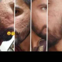 کرم ضد لک سفید کننده