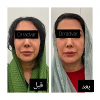 اندولیفت صورت و بدن با دستگاه یوفوتون ایتالیا|خدمات آرایشگری و زیبایی|کرج, شهرک مترو|دیوار