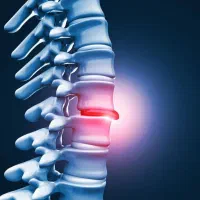 دیسک و سیاتیک با طب ابوعلی سینا