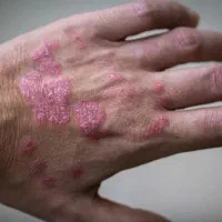 درمان پسوریازیس به صورت ریشه ای