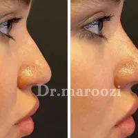 تزریق ژل لب بوتاکس لیفت ابرو کانتورینگ و آموزش|خدمات آرایشگری و زیبایی|تهران, پونک|دیوار