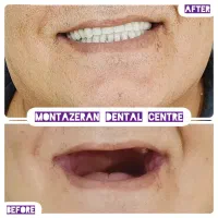 دندانسازی دندانساز دندان مصنوعی دندان باضمانت