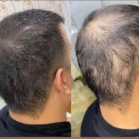 میکرو اسکالپ پر پشت کردن مو طاسی سر ریزش سکه ای