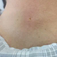 برداشت خال بالیزر بدون خون ریزی در یک جلسه|خدمات آرایشگری و زیبایی|ایلام, |دیوار