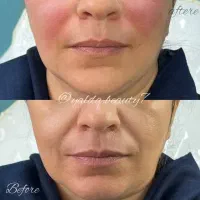 تزریق ژل و بوتاکس با نتیجه ی طبیعی