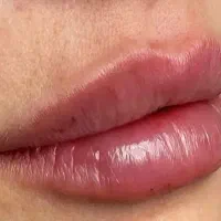 خدمات ژل بوتاکس مزو فیلر انزیم بوتاکس|خدمات آرایشگری و زیبایی|تهران, تهرانسر مرکزی|دیوار