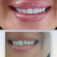 تخفیف کامپوزیت ونیر دندان|خدمات آرایشگری و زیبایی|اردبیل, |دیوار