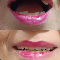 دندانسازی پیرهادی بامتد جدید کنترل لقی دندان|خدمات آرایشگری و زیبایی|ورامین, ورامین|دیوار