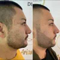 شبیه سازی فولیکول مو smp اس کالپ|خدمات آرایشگری و زیبایی|دوگنبدان, |دیوار