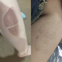 لیزرمو کندلا آمریکایی