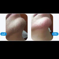 الکترولیز روشی قطعی حذف موهای زائد صورت|خدمات آرایشگری و زیبایی|اشنویه, |دیوار