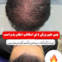 میکرواسکالپ فی اسکالپ سر|خدمات آرایشگری و زیبایی|شیراز, ملاصدرا|دیوار
