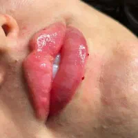 مدل ژل بوتاکس فقط هزینه مواد گرفته میشود