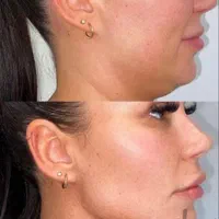 آف تزریق ژل و بوتاکس در کلینیک و سالن
