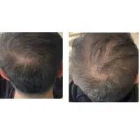 کچلی خب ما درستش میکنیم