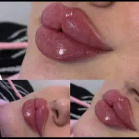 فیلرمزو بوتاکسprpژل اگزوزوم تراپیprf آقایان بانوان