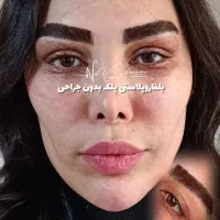 بلفاروپلاستی پلک بدون جراحی