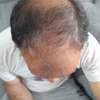 جشنواره کاشت مو پرتراکم 30 میلیون