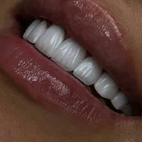 کامپوزیت و لمینت دنتال وست و درمانی