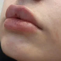 جشنواره کلینیک زیبایی تزریق فیلر، بوتاکس توسط پزشک|خدمات آرایشگری و زیبایی|نجف‌آباد, |دیوار