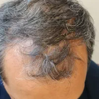کاشت مو و ابرو ریش طبیعی و نچرال و دایمی