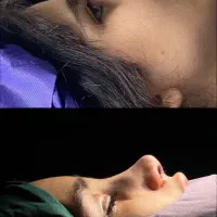 جشنواره محدود جراحی بینی فقط 35 و لیفت صورت|خدمات زیبایی و سلامت|تهران, آرژانتین|دیوار
