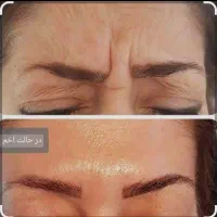 بوتاکس ژل صورت و بدن|خدمات آرایشگری و زیبایی|بیرجند, |دیوار