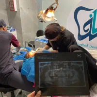 ایمپلنت فوری بابهترین متریال فقط ۱۲۵۰۰