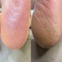 درمان انواع ناخن های داخل گوشت وترک و پینه