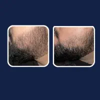 ریش ۲|آرایشی، بهداشتی، درمانی|برازجان, |دیوار